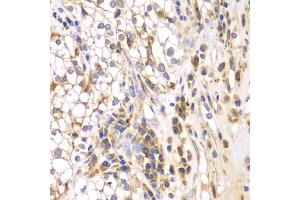 Immunohistochemistry of paraffin-embedded human kidney cancer using SRPK1 antibody (ABIN5973465) at dilution of 1/200 (40x lens). (SRPK1 抗体)