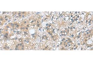 Immunohistochemistry of paraffin-embedded Human liver cancer tissue using RAB39A Polyclonal Antibody at dilution of 1:70(x200) (RAB39A 抗体)