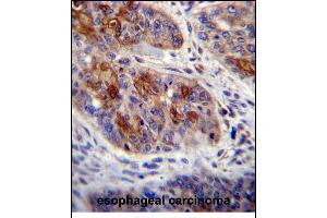 HAX1 Antibody (C-term) (ABIN656245 and ABIN2845562) immunohistochemistry analysis in formalin fixed and paraffin embedded human esophageal carcinoma followed by peroxidase conjugation of the secondary antibody and DAB staining. (HAX1 抗体  (C-Term))