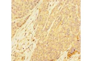 Immunohistochemistry of paraffin-embedded human ovarian cancer using ABIN7168417 at dilution of 1:100 (PDE6A 抗体  (AA 656-860))