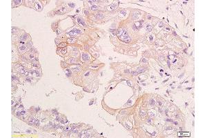 Formalin-fixed and paraffin embedded human colon carcinoma labeled with Anti-CD24 Polyclonal Antibody, Unconjugated  at 1:200, followed by conjugation to the secondary antibody and DAB staining (CD24 抗体  (AA 60-80))