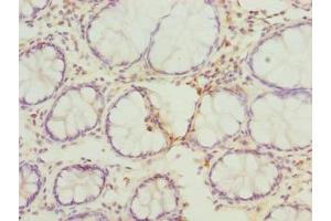 Immunohistochemistry of paraffin-embedded human colon cancer using ABIN7167630 at dilution of 1:100 (FAM82B 抗体  (AA 13-314))