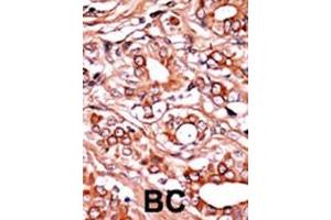 Formalin-fixed and paraffin-embedded human cancer tissue reacted with the primary antibody, which was peroxidase-conjugated to the secondary antibody, followed by AEC staining. (ABL1 抗体  (pTyr134))