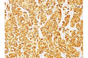 Formalin-fixed, paraffin-embedded human Melanoma stained with MART-1 Monoclonal Antibody (M2-7C10). (MLANA 抗体)