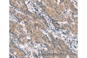 Immunohistochemistry of Human gastric cancer using CRKL Polyclonal Antibody at dilution of 1:25 (CrkL 抗体)