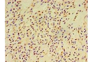 Immunohistochemistry of paraffin-embedded human breast cancer using ABIN7152252 at dilution of 1:100 (EXOC2 抗体  (AA 1-220))
