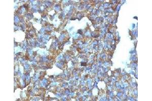Formalin-fixed, paraffin-embedded human ovarian carcinoma stained with CD99 antibody (MIC2/877). (CD99 抗体)