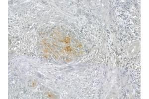 ABIN6258387 and ABIN6274993 at 1/100 staining human tongue carcinoma by IHC-P. (CEP78 抗体  (Internal Region))