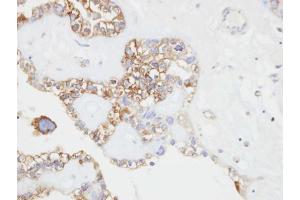 IHC-P Image Immunohistochemical analysis of paraffin-embedded human ovarian cancer, using CD146, antibody at 1:500 dilution. (MCAM 抗体  (N-Term))