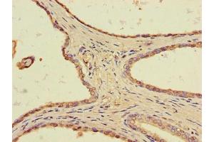 Immunohistochemistry of paraffin-embedded human prostate cancer using ABIN7172291 at dilution of 1:100 (TLL1 抗体  (AA 522-643))