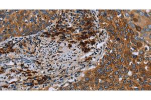 Immunohistochemistry of paraffin-embedded Human cervical cancer using HYAL3 Polyclonal Antibody at dilution of 1:40 (HYAL3 抗体)