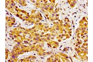 Immunohistochemistry of paraffin-embedded human liver cancer using ABIN7170770 at dilution of 1:100 (CYP27A1 抗体  (AA 290-407))