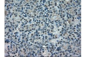 Immunohistochemical staining of paraffin-embedded Carcinoma of thyroid tissue using anti-PORmouse monoclonal antibody. (POR 抗体)