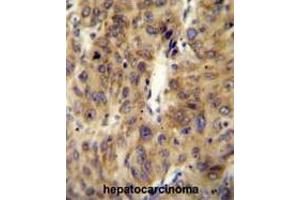 ACF Antibody (C-term) immunohistochemistry analysis in formalin fixed and paraffin embedded human hepatocarcinoma followed by peroxidase conjugation of the secondary antibody and DAB staining. (A1CF 抗体  (C-Term))