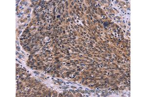 Immunohistochemistry of Human colon cancer using CDC5L Polyclonal Antibody at dilution of 1:30 (CDC5L 抗体)