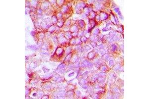 Immunohistochemical analysis of EPHB1/2 staining in human breast cancer formalin fixed paraffin embedded tissue section. (EPHB1/2 抗体)