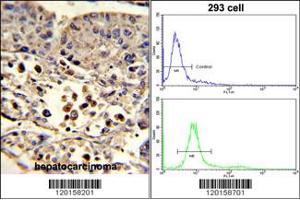 (LEFT)Formalin-fixed and paraffin-embedded human hepatocarcinoma reacted with ETHE1 Antibody , which was peroxidase-conjugated to the secondary antibody, followed by DAB staining. (ETHE1 抗体  (C-Term))