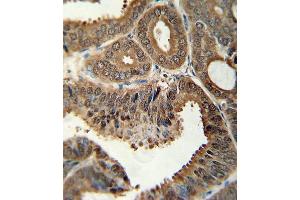 Formalin-fixed and paraffin-embedded human colon carcinoma tissue reacted with ITGA6 Antibody (isoform 2 ) (ABIN389229 and ABIN2839381) , which was peroxidase-conjugated to the secondary antibody, followed by DAB staining. (ITGA6 抗体  (Isoform 2))