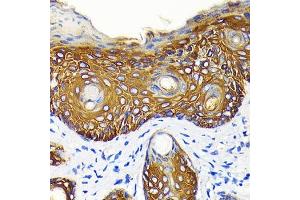Immunohistochemistry of paraffin-embedded human skin cancer using Cytokeratin 14 (KRT14) (KRT14) Rabbit mAb (ABIN7268091) at dilution of 1:100 (40x lens). (KRT14 抗体)