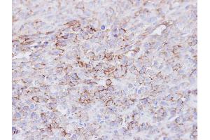 IHC-P Image Immunohistochemical analysis of paraffin-embedded MDAMB231 xenograft, using CD73, antibody at 1:100 dilution. (CD73 抗体)