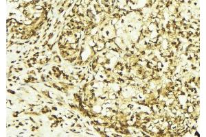ABIN6267618 at 1/100 staining Human breast cancer tissue by IHC-P. (PKC delta 抗体  (pTyr313))