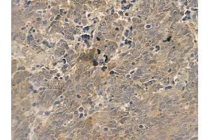 ABIN6262671 and ABIN6273002 at 1/100 staining human small cell lung carcinoma by IHC-P.