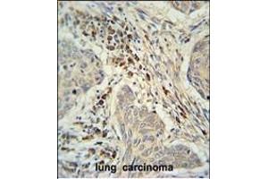 C19orf50 Antibody (Center) (ABIN653085 and ABIN2842681) immunohistochemistry analysis in formalin fixed and paraffin embedded human lung carcinoma followed by peroxidase conjugation of the secondary antibody and DAB staining. (C19orf50 抗体  (AA 59-85))