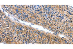 Immunohistochemistry of paraffin-embedded Human liver cancer tissue using ARL11 Polyclonal Antibody at dilution 1:50 (ARL11 抗体)