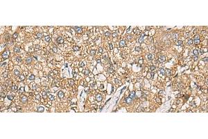 Immunohistochemistry of paraffin-embedded Human liver cancer tissue using CHKA Polyclonal Antibody at dilution of 1:35(x200) (Choline Kinase alpha 抗体)