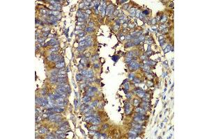 Immunohistochemistry of paraffin-embedded human colon carcinoma using QARS antibody at dilution of 1:100 (x40 lens). (QARS 抗体)
