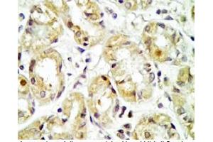 Human stomach cancer tissue was stained by rabbit Anti-Spexin prepro (36-58)  Antibody (Spexin 抗体  (Preproprotein))