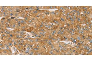 Immunohistochemistry of paraffin-embedded Human liver cancer using TPD54 Polyclonal Antibody at dilution of 1:35 (TPD52L2 抗体)