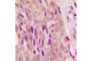 Immunohistochemical analysis of SMAD4 staining in human breast cancer formalin fixed paraffin embedded tissue section. (SMAD4 抗体  (N-Term))