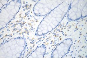 Immunohistochemistry was performed on paraffin-embedded human sigmoid colon carcinoma using p53 antibody (ABIN7800686), 1:200).