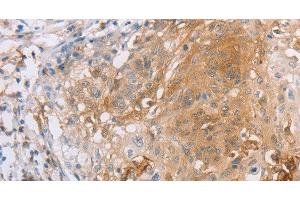 Immunohistochemistry of paraffin-embedded Human cervical cancer tissue using CD85d Polyclonal Antibody at dilution 1:30 (LILRB2 抗体)