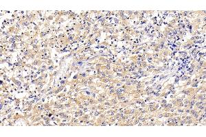 Detection of LAMP2 in Human Liver cancer Tissue using Polyclonal Antibody to Lysosomal Associated Membrane Protein 2 (LAMP2) (LAMP2 抗体  (AA 193-375))