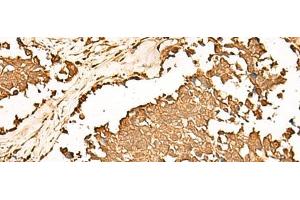 Immunohistochemistry of paraffin-embedded Human lung cancer tissue using PWP1 Polyclonal Antibody at dilution of 1:70(x200) (PWP1 抗体)