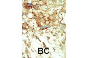 Formalin-fixed and paraffin-embedded human cancer tissue reacted with the primary antibody, which was peroxidase-conjugated to the secondary antibody, followed by DAB staining. (Ret Proto-Oncogene 抗体  (C-Term))