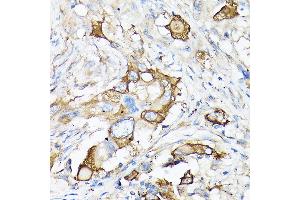 Immunohistochemistry of paraffin-embedded human lung cancer using MMP7 Rabbit pAb (ABIN3021102, ABIN3021103, ABIN3021104, ABIN1513214 and ABIN6213952) at dilution of 1:150 (40x lens). (MMP7 抗体  (AA 18-267))