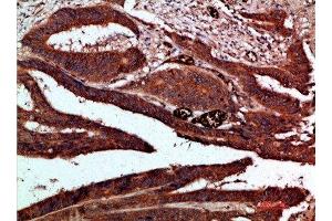Immunohistochemical analysis of paraffin-embedded human-colon-cancer, antibody was diluted at 1:200 (CDK6 抗体  (AA 280-325))