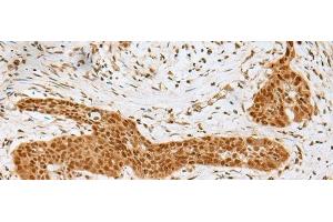 Immunohistochemistry of paraffin-embedded Human esophagus cancer tissue using GOLGA7 Polyclonal Antibody at dilution of 1:40(x200) (Golgin A7 抗体)