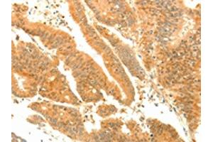 The image on the left is immunohistochemistry of paraffin-embedded Human colon cancer tissue using ABIN7131139(SOCS6 Antibody) at dilution 1/35, on the right is treated with fusion protein. (SOCS6 抗体)