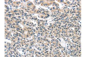The image on the left is immunohistochemistry of paraffin-embedded Human liver cancer tissue using ABIN7131349(THSD1 Antibody) at dilution 1/25, on the right is treated with fusion protein. (THSD1 抗体)