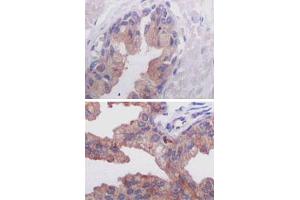 Immunohistochemical analysis of paraffin-embedded human normal prostate tissue (A) and prostate adenocarcinoma tissue (B), showing cytoplasmic localization using AMACR monoclonal antibody, clone 2A10F3  with DAB staining. (AMACR 抗体)
