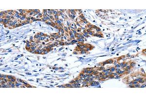 Immunohistochemistry of paraffin-embedded Human esophagus cancer tissue using AQP8 Polyclonal Antibody at dilution 1:75 (Aquaporin 8 抗体)