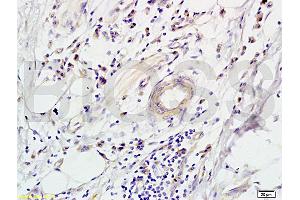 Formalin-fixed and paraffin-embedded human colon carcinoma labeled with Rabbit Anti-CD118 Polyclonal Antibody (ABIN686827), Unconjugated 1:200 followed by conjugation to the secondary antibody and DAB staining (LIFR 抗体  (AA 451-580))