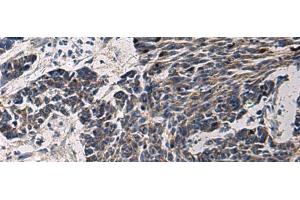 Immunohistochemistry of paraffin-embedded Human colorectal cancer tissue using CCNI Polyclonal Antibody at dilution of 1:65(x200) (Cyclin I 抗体)