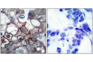 Immunohistochemical analysis of paraffin-embedded human breast carcinoma tissue using EGFR(Phospho-Tyr1197) Antibody(left) or the same antibody preincubated with blocking peptide(right). (EGFR 抗体  (pTyr1197))