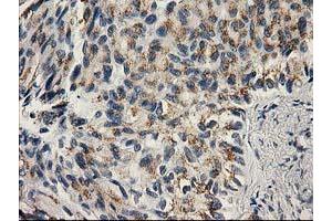 Immunohistochemical staining of paraffin-embedded Carcinoma of Human lung tissue using anti-PNMT mouse monoclonal antibody. (PNMT 抗体)