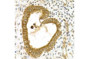 Immunohistochemistry of paraffin-embedded human adenomyosis using RAB27A Antibody (ABIN5970998) at dilution of 1/200 (40x lens). (RAB27A 抗体)